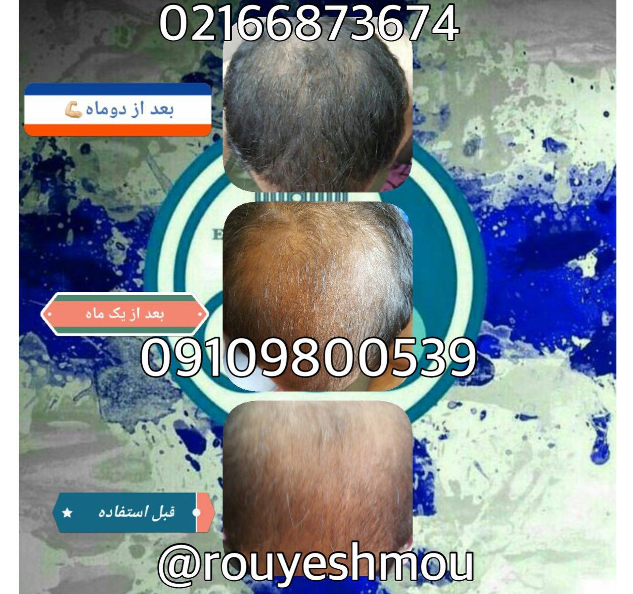 درمان ریزش مو با آب پیاز وعسل