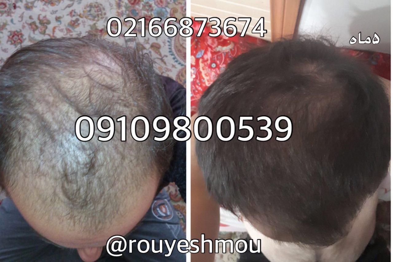 رشد سریع موهای ریخته شده با ماسک موی گیاهی