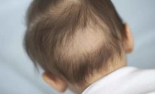 دلایل ریزش مو در کودکان چیست
