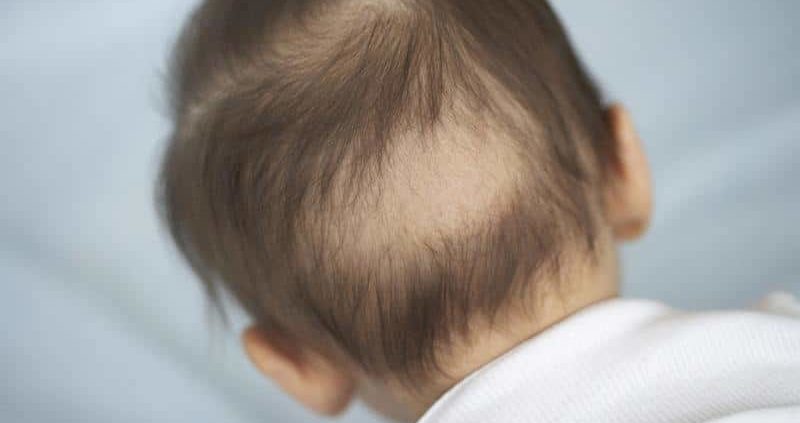 دلایل ریزش مو در کودکان چیست